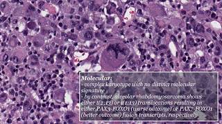 Pleomorphic Rhabdomyosarcoma [upl. by Eahc471]