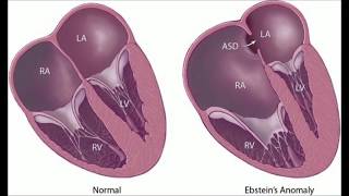 Ebsteins Anomaly [upl. by Lotsyrk]