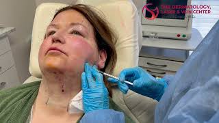 Masseter Botox Injections Reshape Your Jawline and Relieve Jaw Tension  Dr Shalini Gupta [upl. by Dayiz]