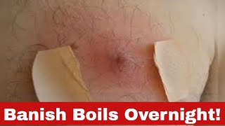 Quick Relief How to Get Rid of a Boil Overnight [upl. by Susannah]