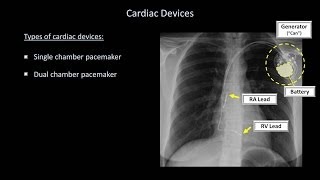 How to Interpret a Chest XRay Lesson 9  Atelectasis Lines Tubes Devices and Surgeries [upl. by Ailahk]