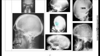 شرح أشعة العظام Bone XRays د محمود سويلم [upl. by Eeslek]