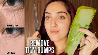 HOW TO REMOVE TINY BUMPS ON YOUR FACE Theyre NOT Acne  MILIA [upl. by Martin783]