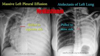 pleural effusion vs atelectasis [upl. by Airad]