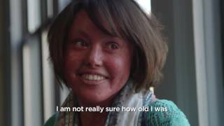 What is Ichthyosis [upl. by Sairu]