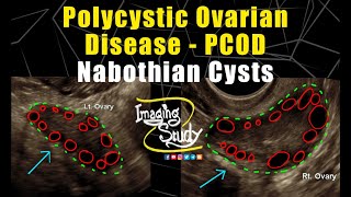 Polycystic Ovarian Disease with Nabothian Cysts  PCOD  Ultrasound  TVS  Case 256 [upl. by Yehs]