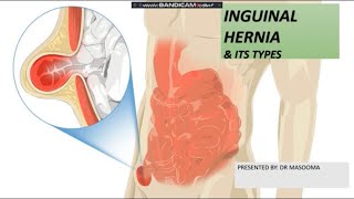 INGUINAL HERNIA [upl. by Dominy]