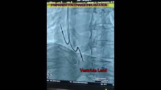 Permanent pacemaker implantation is a surgical procedure  🫀 [upl. by Kylstra]