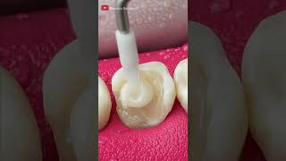 Unbelievable Tooth Restoration asmr restoration [upl. by Maurreen]