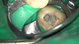 Endoseal root canal filling [upl. by Furey]