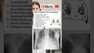 Chest X Ray of Lung Edema medical doctor nursing [upl. by Chill]