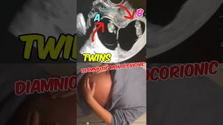 Double joy Twins ultrasound  Diamniotic Monochorionic  Girls pregnancy babyshorts [upl. by Medovich]