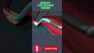 Cardiology Stent Deployment Procedure [upl. by Eetsirk]