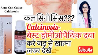 Calcinosis कल्सिनोसिसकलसियम का ज़्यादा होनाHomeopathyBest Treatment By DrRukmani Choudhary [upl. by Soraya]