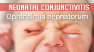 Conjunctiva  purulent conjunctivitis  Ophthalmia neonatorum Part 3 [upl. by Nolrak]