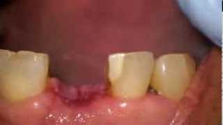 Suture removal after a dental implant placement [upl. by Heywood]