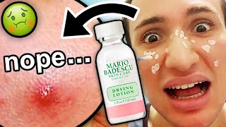 I tried Mario Badescu DRYING LOTION for ONE WEEK I was shocked honey [upl. by Reynolds454]