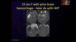 Brain Arteriovenous Malformations and Hereditary Hemorrhagic Telangiectasia HHT [upl. by Horacio]