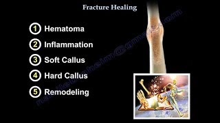 Fracture Healing  Everything You Need To Know  Dr Nabil Ebraheim [upl. by Einneb]