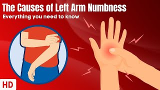 The Causes Of Left Arm Numbness [upl. by Ah]