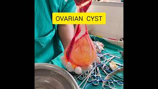 Ovarian Cyst ovariancancer ovaries cyst cancer gynaecology obstetricsandgynecology shorts [upl. by Eirtemed619]