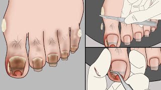 ASMR Ingrown Toenail Removal Treatment AnimationStrong Satisfaction  Mengs Stop Motion [upl. by Terryl]