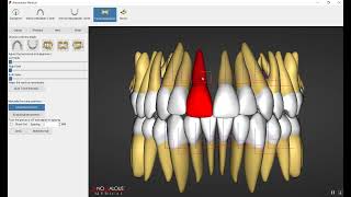 Orthognathic Surgery Part 5 المرحلة الخامسة [upl. by Sjoberg]