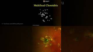 Multifocal Choroiditis Symptoms and Treatment ophthalmology optometry [upl. by Nahem231]