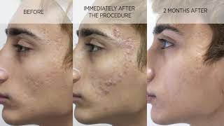 Acne scar subcision and filler [upl. by Lianna]