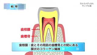 歯根膜炎／ミルメディカル 家庭の医学 動画版 [upl. by Litnahs]