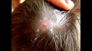 Botfly removed from head [upl. by Anikal]