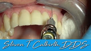 Painless and Profound Maxillary Anterior Local Anesthesia  Dental Minute with Steven T Cutbirth [upl. by Haik]