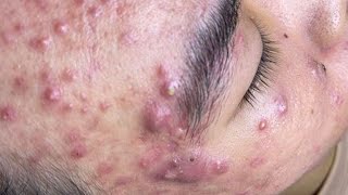 Big Cystic Acne Blackheads Extraction Blackheads amp Milia Whiteheads Removal Pimple Popping  698 [upl. by Wieren200]