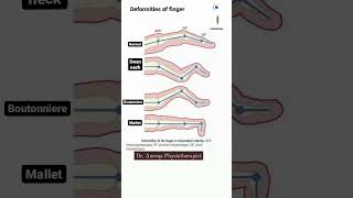 finger deformity swan neck mallet boutonniere shorts shortvideo anatomy medical [upl. by Enirahtak617]