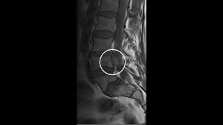 L3 L4 Microdiscectomy  Laminectomy Morning of [upl. by Atnoed]