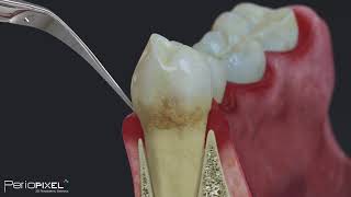 Tratamiento Periodontal Básico para pacientes [upl. by Vernice]