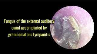 Fungus of the external auditory canal accompanied by granulomatous tympanitis [upl. by Nosittam]