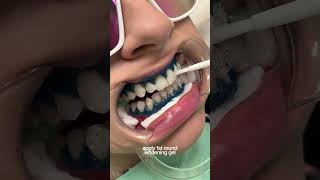 teeth whitening process 🦷 torontoteethwhitening teethwhitening [upl. by Primrose]