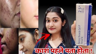 Benzoyl Peroxide Gel 25 review  Benzoyl peroxide gel 25  Benzoyl peroxide for acne [upl. by Wivinah519]