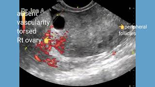 Torsion ovary sonography ultrasound and color Doppler video [upl. by Hut]