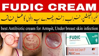 fudic cream uses  fusidic acid cream  antibacterial cream  best cream for acne  infected wound [upl. by Nilauqcaj791]