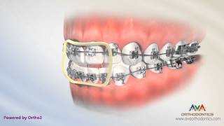 Orthodontic Treatment for Openbite  Rubber Bands [upl. by Felicdad]