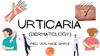 Urticaria  Dermatology Pathophysiologyclinical featuresdiagnosistreatment MedVidsMadeSimple [upl. by Dnalra291]