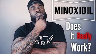 Does Minoxidil Really Work  Minoxidil Beard Growth [upl. by Barnes412]