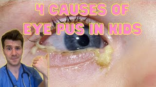 Doctor explains 4 causes of eye pus discharge or sticky eyes in kids  Doctor ODonovan [upl. by Enialedam]