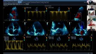 Aortic Stenosis 1 [upl. by Aikemahs]