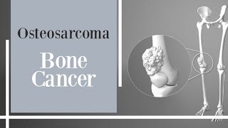 bone cancer  Osteosarcoma [upl. by Harrad109]