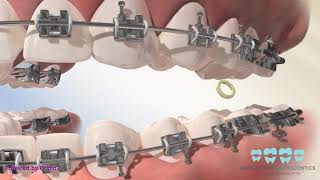 Posterior Crossbite Elastics [upl. by Strauss726]