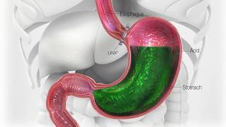 3 Ways to Stop ACID REFLUX Naturally  How to Stop Acid Reflux amp HEARTBURN [upl. by Eyaf]