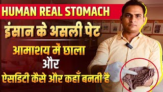 FullVideoAcidity amp Gastric Ulcer in Real Stomach  इंसान के असली पेट में ऐसिडिटी और छाले viral [upl. by Atinrahs]